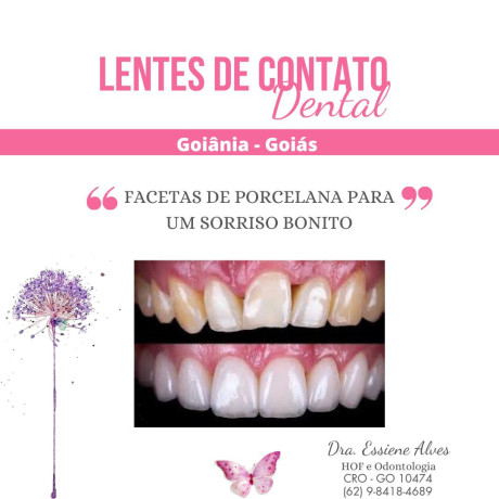 facetas-porcelana-goiania-goias-big-4